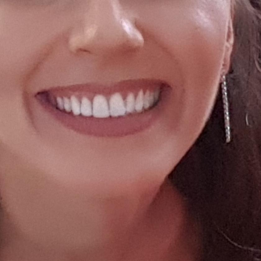 Wybielanie zębów metodą nakładkową Stomatolog Karolina Syska - Jurek